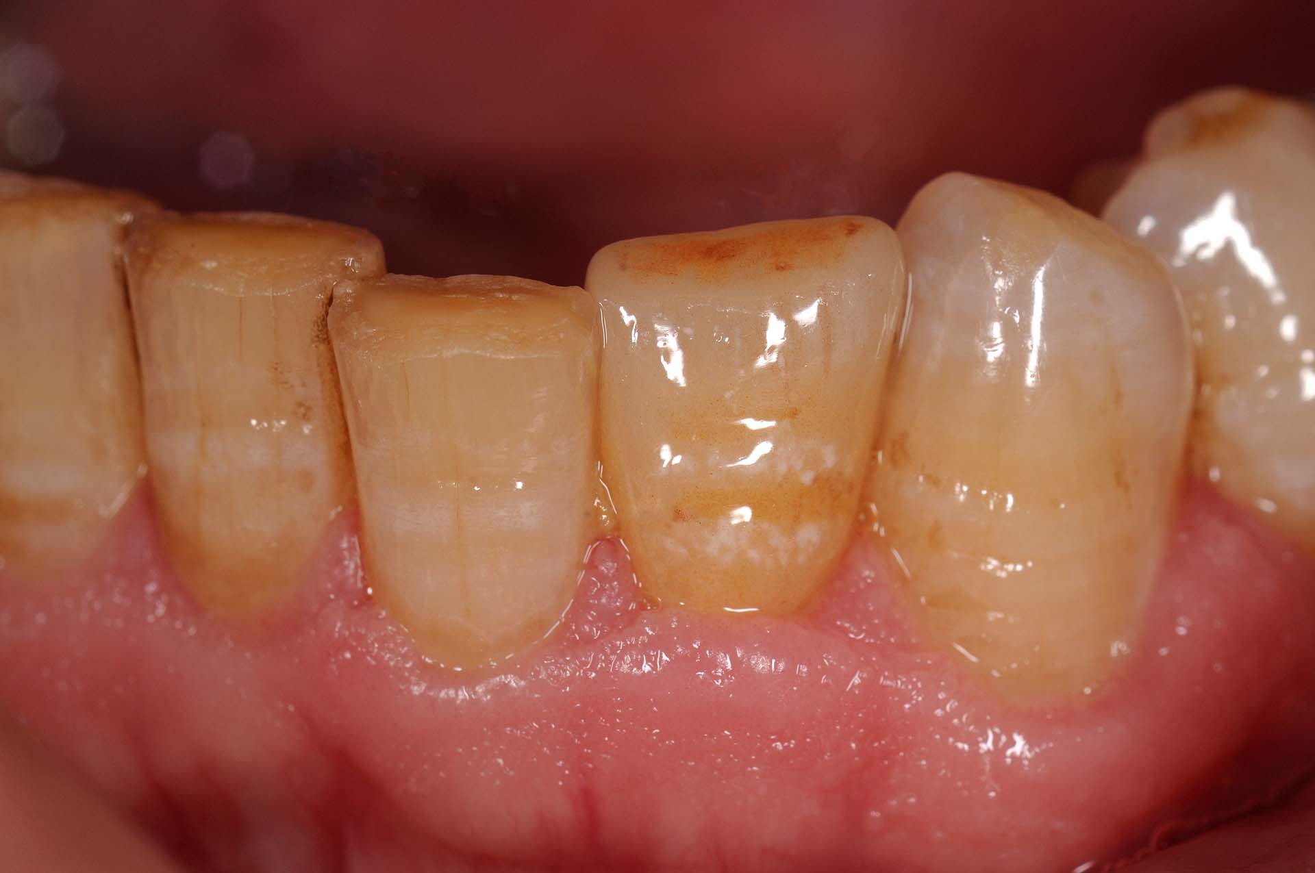 Veneer 32